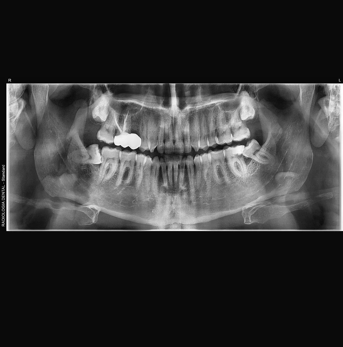 Radiografía panorámica de los maxilares y los dientes