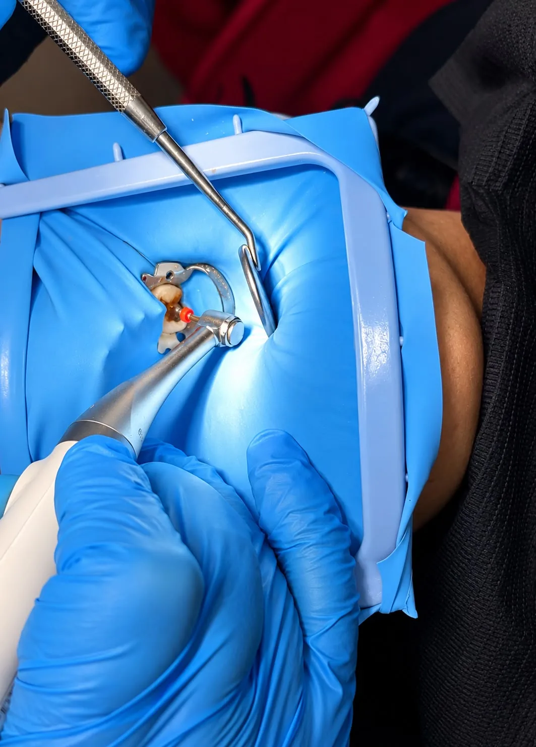 Tratamiento de conductos con aislamiento de goma sobre un molar