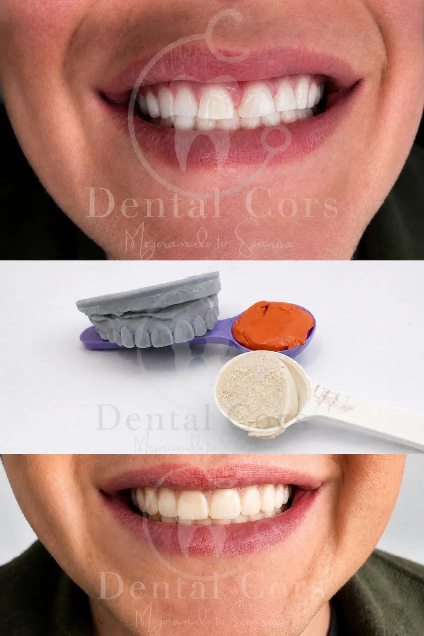 Sonrisa antes y después de un tratamiento estético, con modelo de estudio