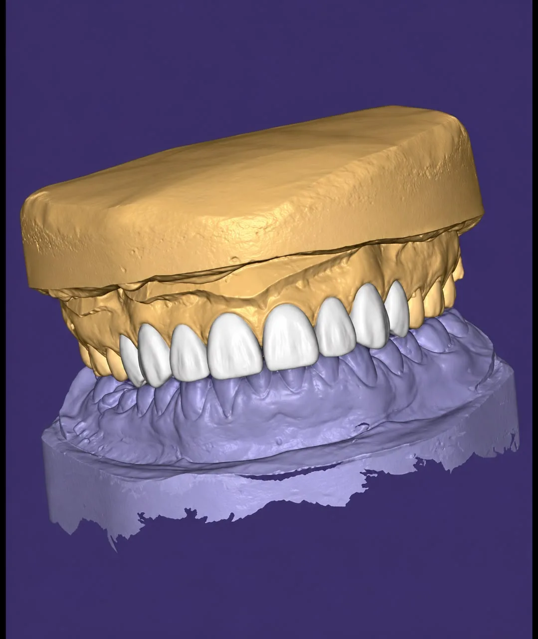 Diseño digital de una sonrisa sobre modelos dentales en 3D
