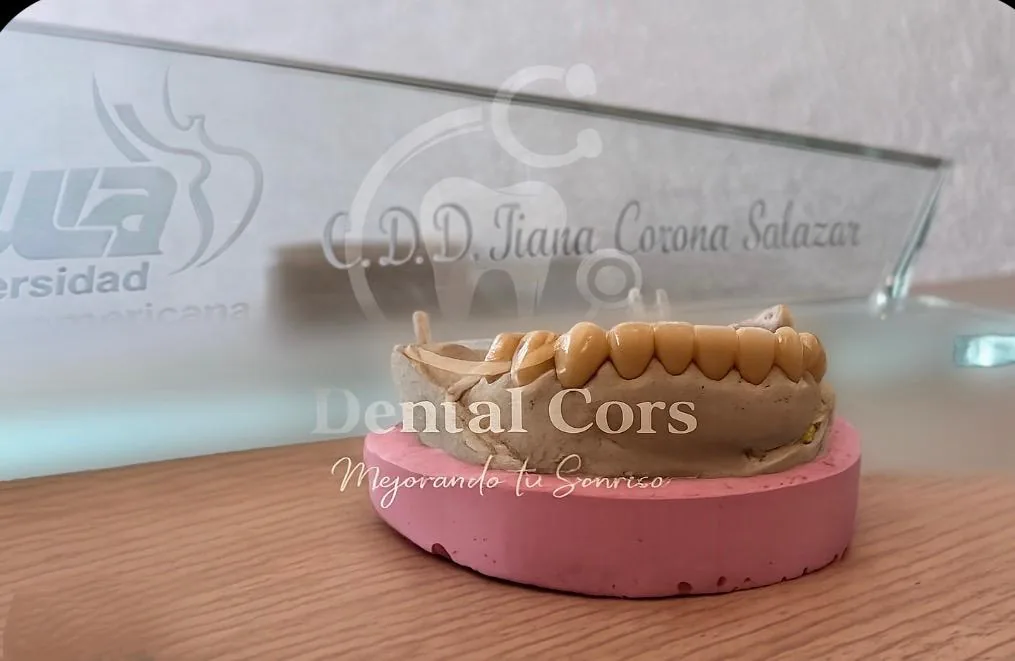 Modelo dental con restauraciones estéticas en Dental Cors