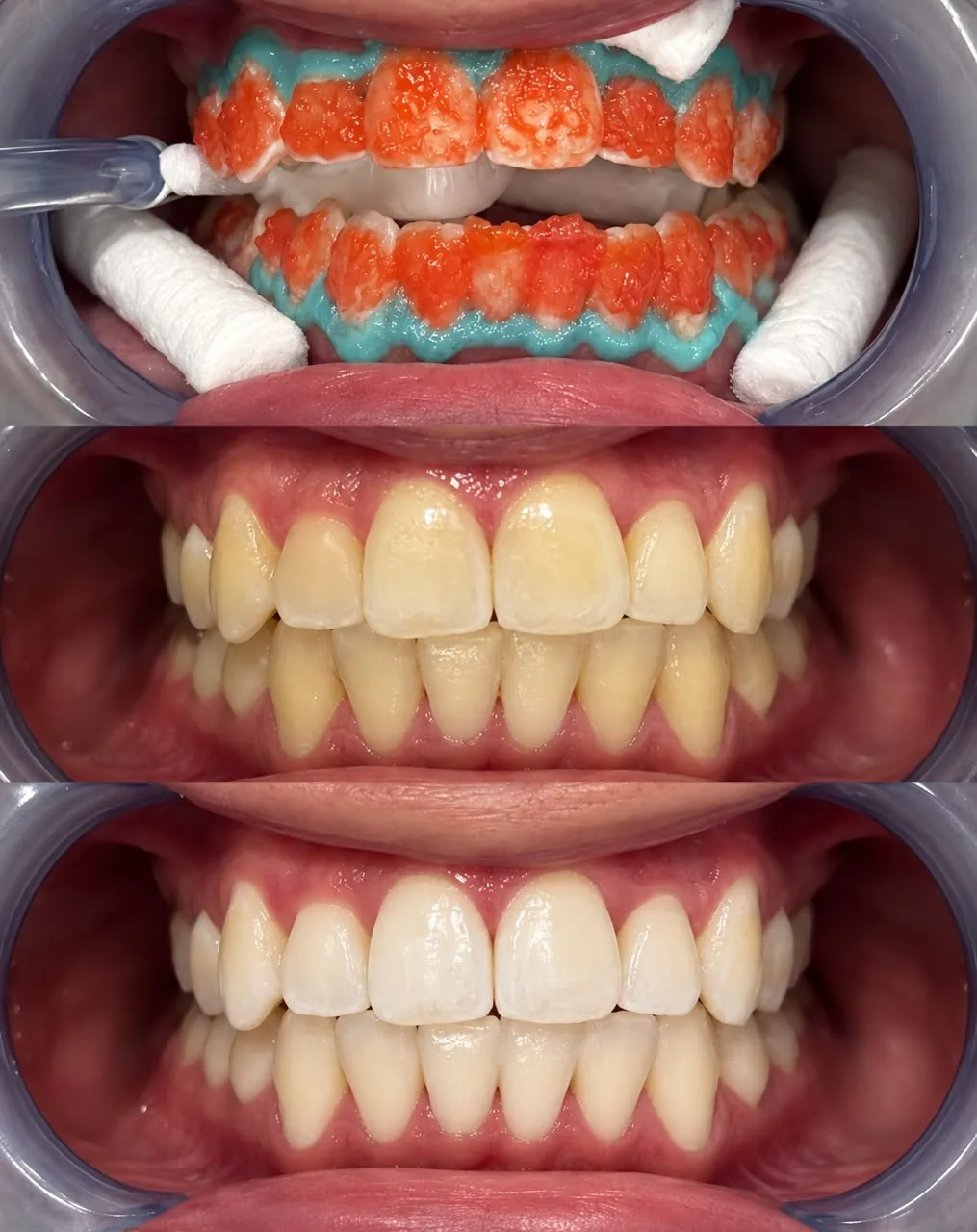 Proceso y resultado de un blanqueamiento dental: aplicación del gel, antes y después