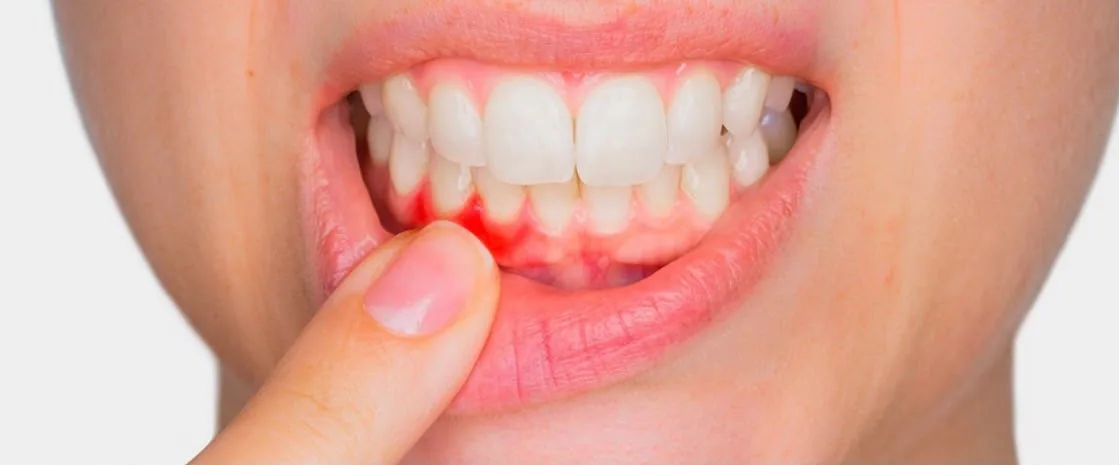 Periodoncia